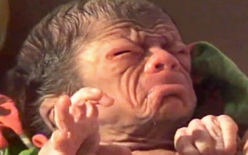 PIC FROM CATERS NEWS - (PICTURED: A baby boy who was born with a condition called Progeria in Bangladesh.) - A real life curious case of Benjamin Button has emerged following the birth of a baby boy who looks like an 80-year-old man. The baby was born in the district of Magura, Bangladesh, on Sunday. Local doctors, who have been left stunned, say the baby suffers from a rare condition called progeria. The baby boy has wrinkles on the face, has a very shrunken body and hollow eyes. The baby does not look like a new born at all. There are prominent sings of ageing such a excessive wrinkles and rough skin texture, said a doctor who has been treating the baby. However, the parents of the baby are jubilant with the birth of their miracle child. SEE CATERS COPY.